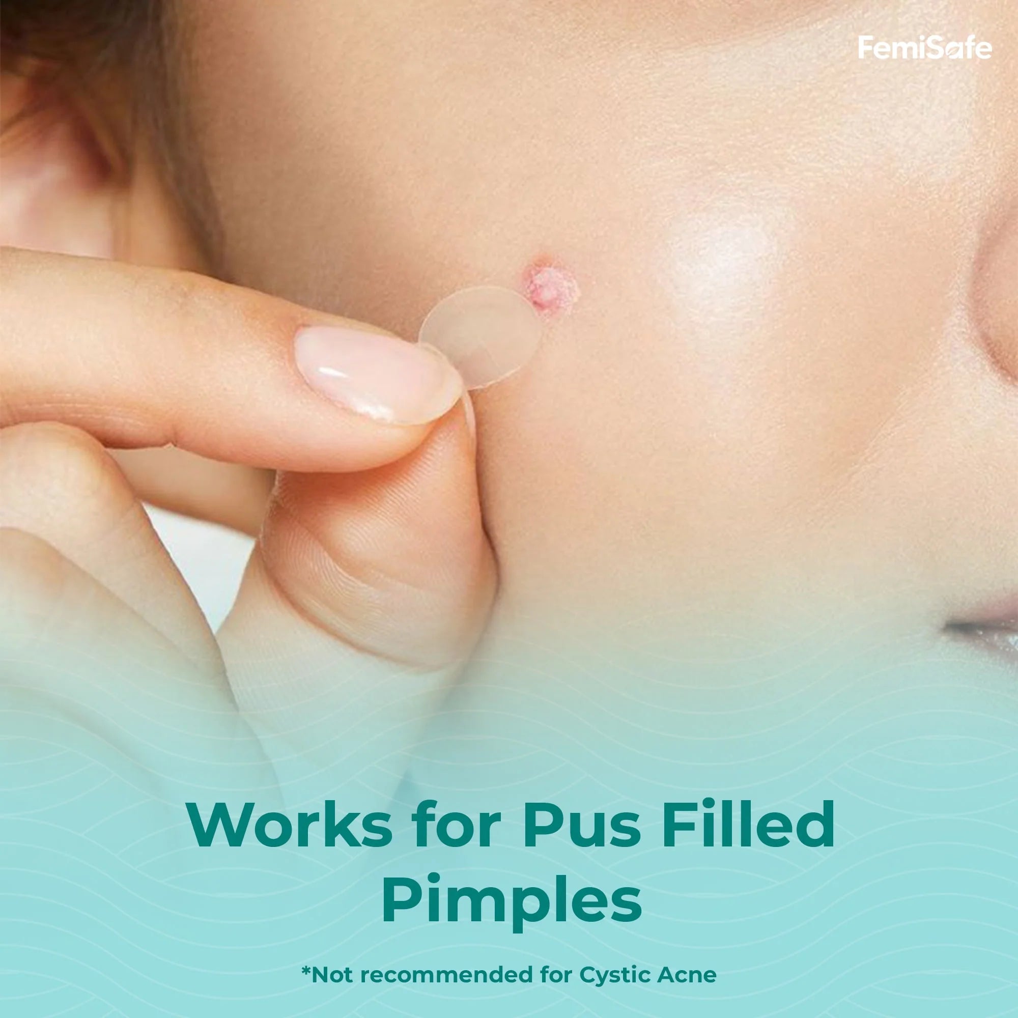 ACNE PIMPLE PATCH