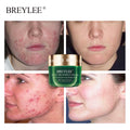 BREYLEE Tea Tree Acne Cream Acne Cream BL-28