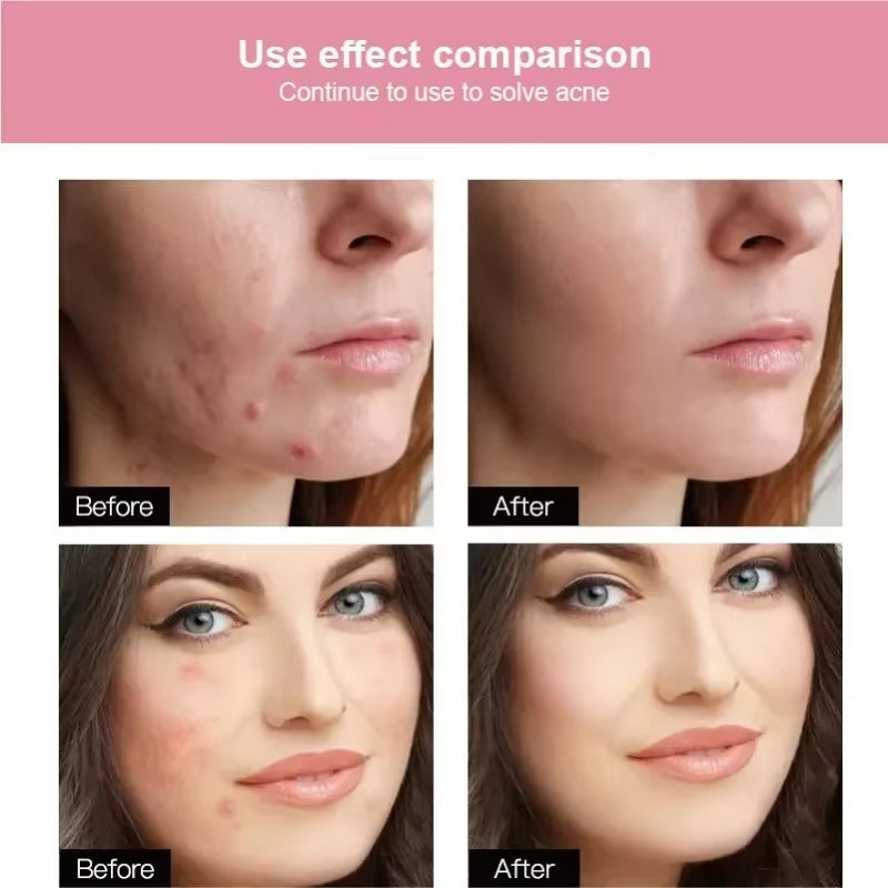 72/180Pcs Hydrocolloid Acne Patch Waterproof Acne Removing PU Film Face Printing Spots Marks Invisible Acne Cleansing Patch